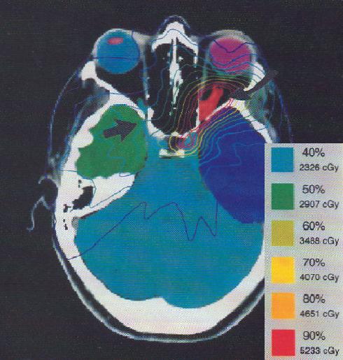File:ONSM Radiation Treatment.jpg