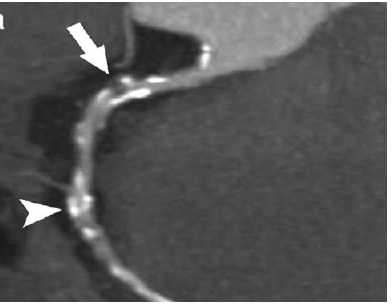 File:Ct-angiography.png