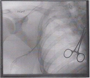 File:A-case-of-Paget-Schroetter-syndrome-(PSS)-in-a-young-judo-tutor-a-case-report-13256 2016 848 Fig1 HTML.jpg