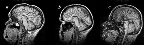 File:Agenesis.jpg
