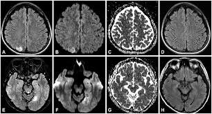File:Brain MRIs of Stroke-Like Lesions typical of MELAS.jpg