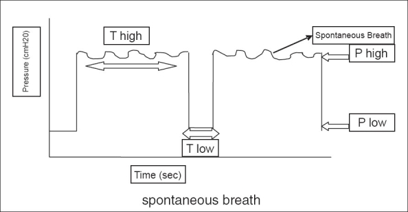 File:Airway pressure release ventilation figure 2007.jpg
