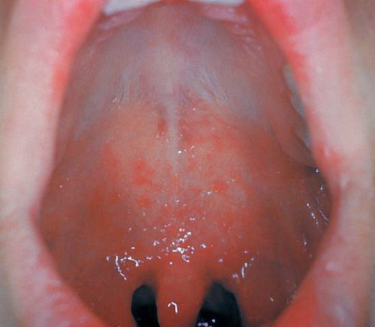 File:Measles enanthema.jpg