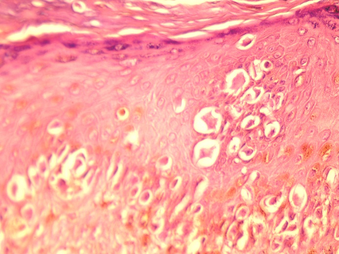 File:Superficially spreading melanoma.jpg