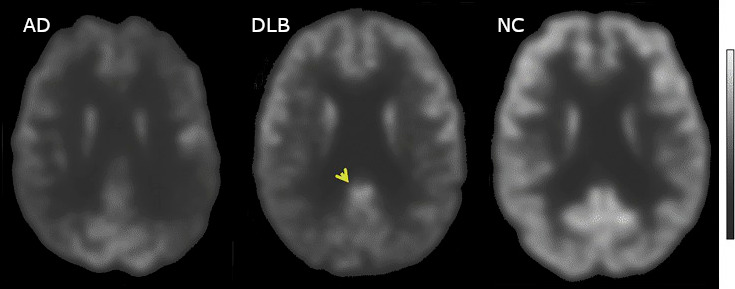 File:FDG Alzheimer Disease and Dementia with Lewy Bodies.jpg
