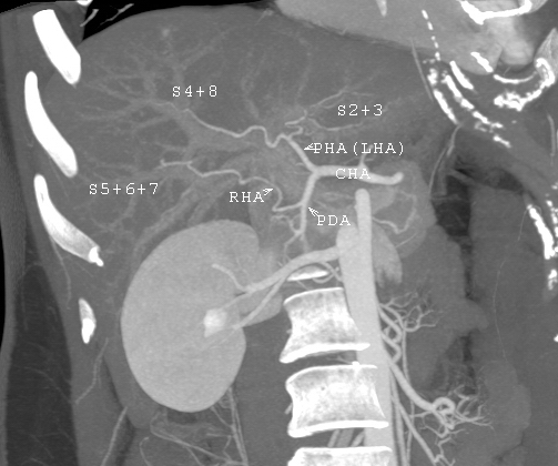 File:CT scan showing liver and kidney.jpg