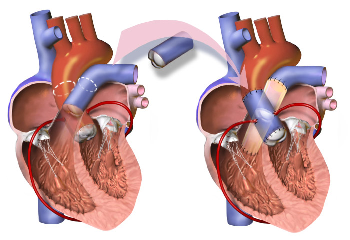 File:Ross Procedure.png