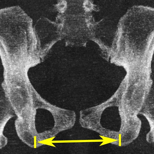 File:Low-dose CT scan of intertuberous diameter.jpg