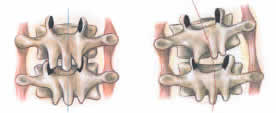 File:Intertransversarii muscles.jpg