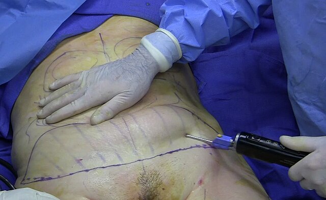 File:Liposuction.jpg