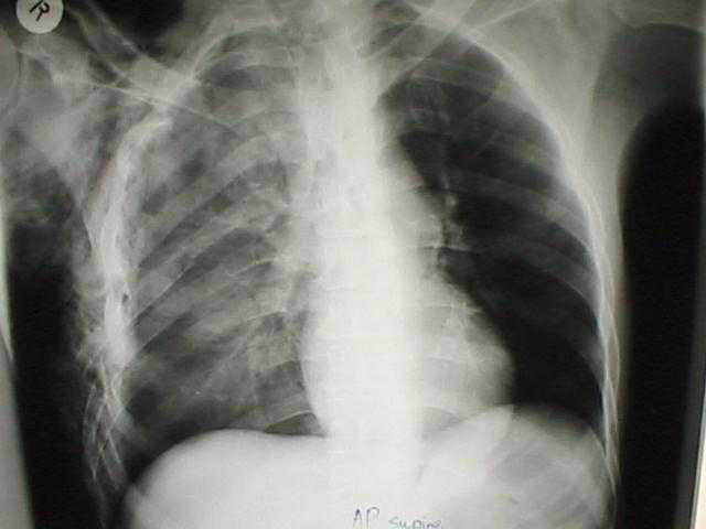 File:Pulmonary contusion.jpg