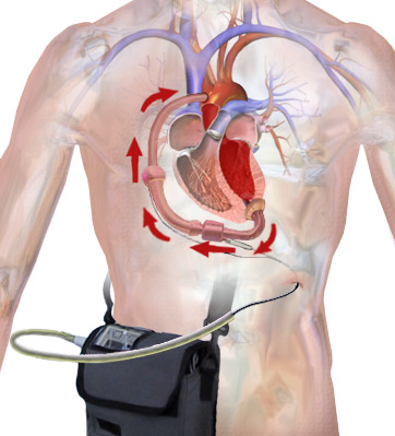 File:Ventricular Assist Device (Power Pack).png