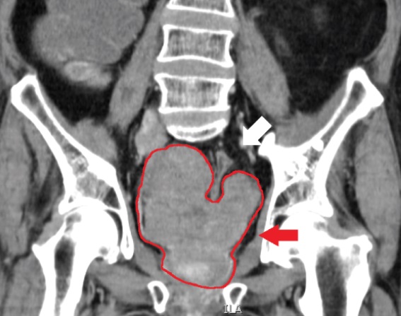 File:CT of prostate cancer.jpg