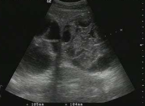 File:Ultrasonography of a hydatid liver cyst.jpg