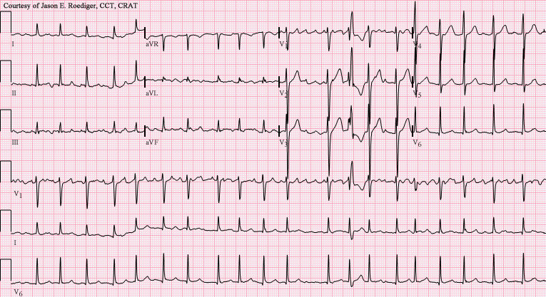 File:AF with RVR-Ashmans phenomenon-RBBB aberrancy.png