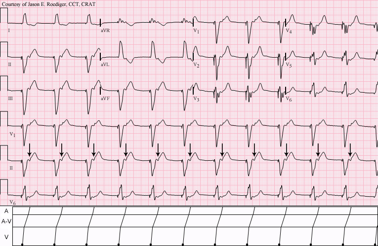 File:V-paced with 1-to-1 retroconduction.png
