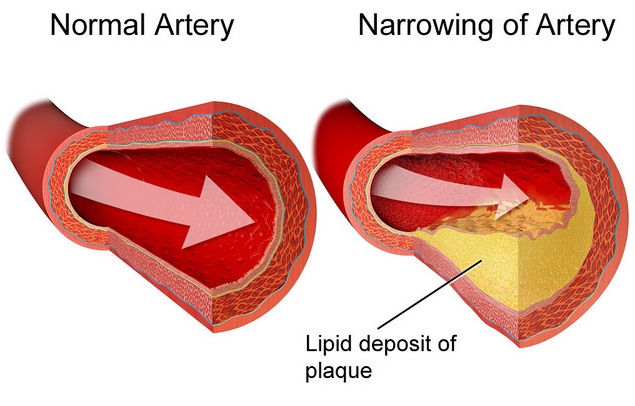 File:Atherosclerosis.jpg