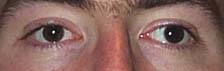 File:Strabismus.jpg