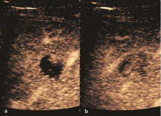File:Contrast-enhanced ultrasound of hepatic hemangioma.jpg