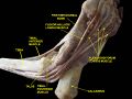 First metatarsal bone