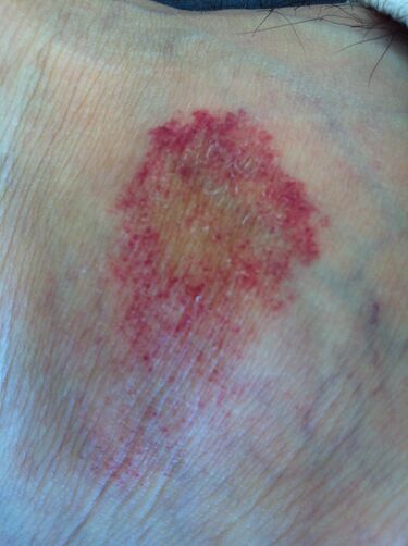 File:Purpura annularis telangiectodes.JPG