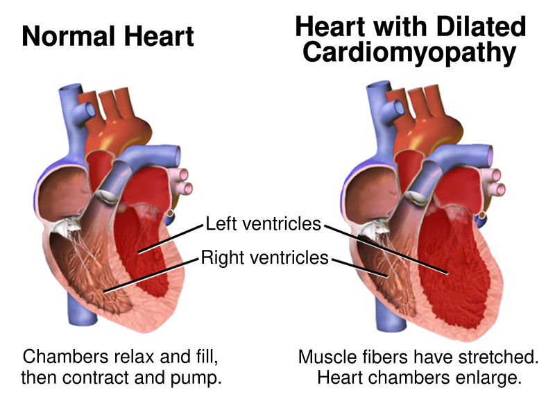 File:Blausen 0165 Cardiomyopathy Dilated.svg