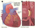 Animation of a heart attack