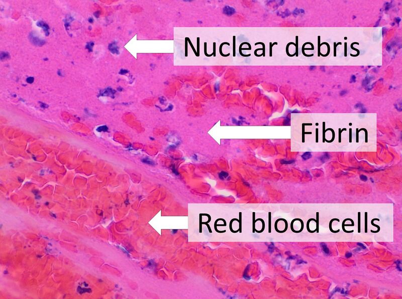 File:Composition of a fresh thrombus.jpg