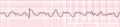 Pediatric advanced life support