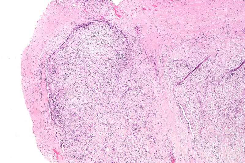 File:Nodular fasciitis - low mag.jpg