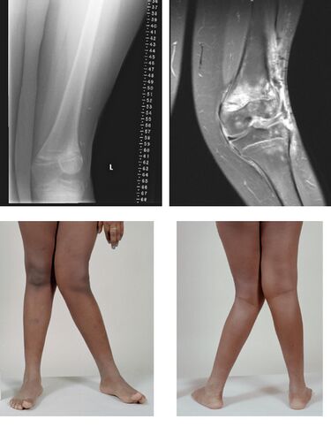 File:Valgus.jpg