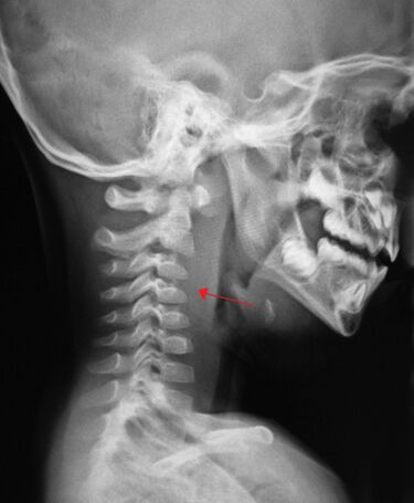 File:Retroabscess10.JPG