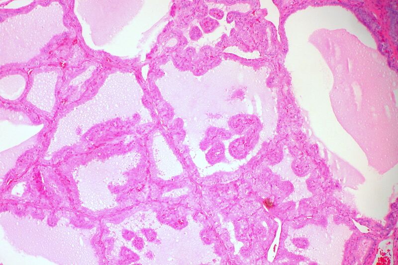File:Diffuse Thyroid Hyperplasia (3334012426).jpg