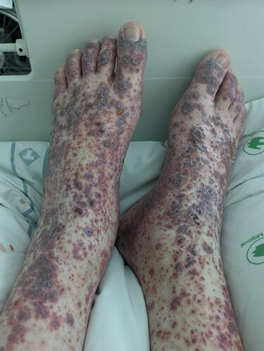 File:HSP Vasculitis.jpg