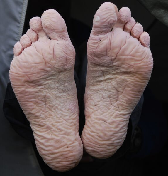 File:Trench foot.jpg