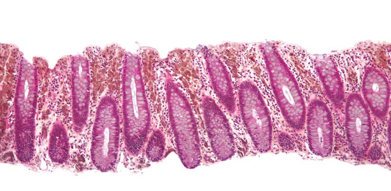 File:Melanosis coli low mag.jpg