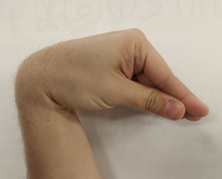 File:Trousseau's Sign of Latent Tetany.jpg