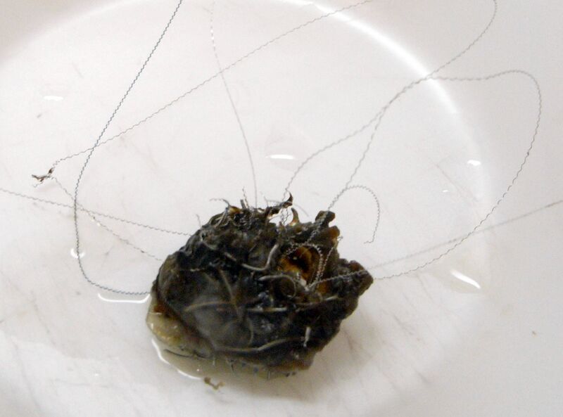 File:Aneurysma Coil.jpg