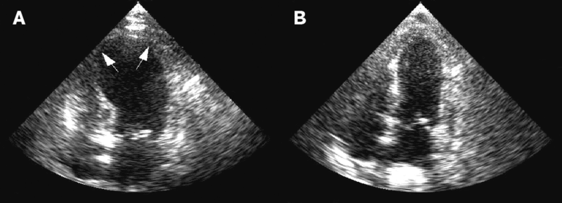 File:Takotsubo ultrasound.gif