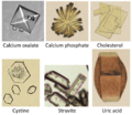Urine crystals comparison