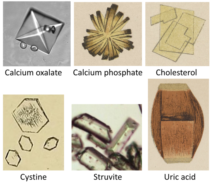 File:Urine crystals comparison.png