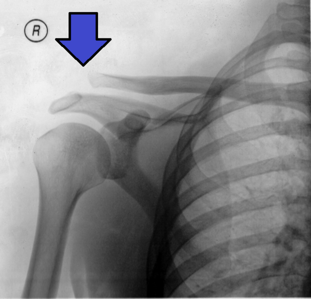 File:AC Separation XRAY (enhanced).png