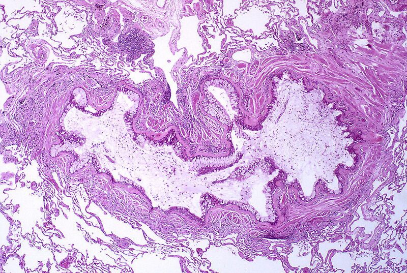 File:Asthma .jpg