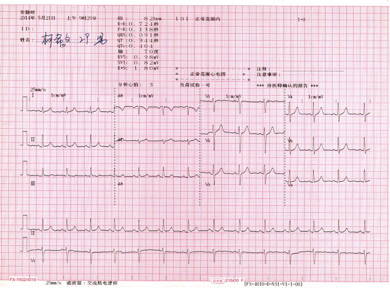 File:Normal 12 lead EKG.jpg