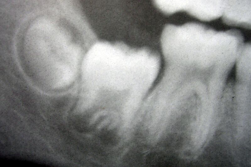 File:Molarsindevelopment11-24-05.jpg