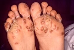 Feet in Reiters syndrome