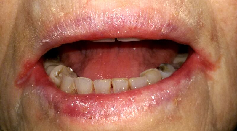 File:Angular cheilitis1.jpg