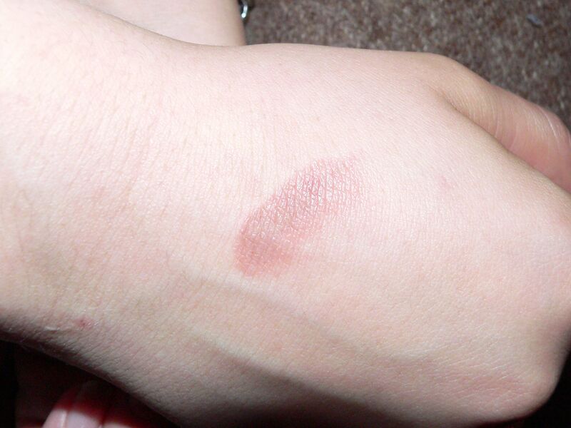 File:Burn 2nd degree 2.jpg