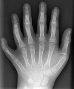 Polydactyly of left hand AP