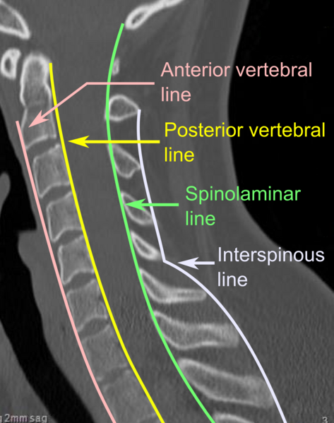 File:Vertebral lines.png